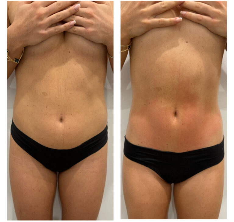 before and after result of a lymphatic massage